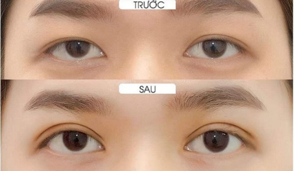 Trước và sau khi tạo hình thẩm mỹ mắt giúp khuôn mắt trở nên trẻ trung hơn