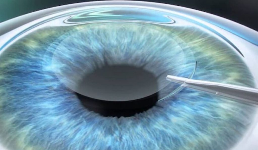 Vạt giác mạc được nâng lên, chiếu laser điều chỉnh và đặt lại trong phẫu thuật LASIK
