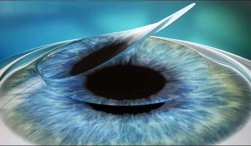 Vạt giác mạc là lớp mô mỏng được tách ra trong phẫu thuật LASIK để điều chỉnh thị lực