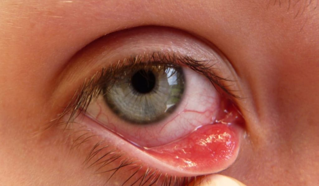 Viêm kết mạc nhiễm trùng gây lòng trắng mắt bị phồng rộp, đỏ mắt và chảy nước mắt