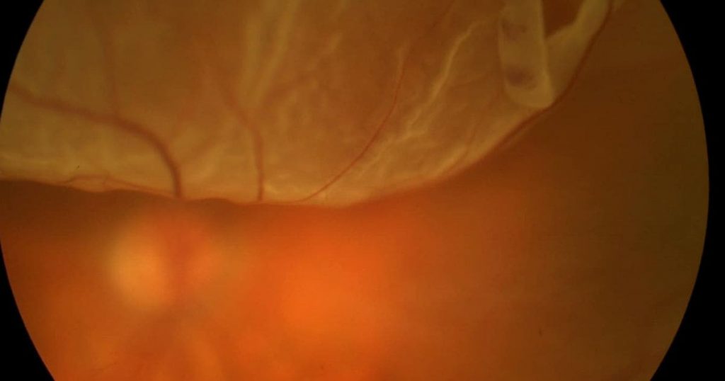 Võng mạc có thể bị bong khiến người bệnh nhìn lóe sáng, thậm chí bị mù loà nếu không điều trị kịp thời