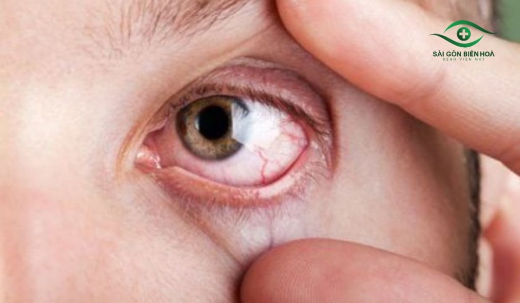 Bệnh võng mạc khiến mắt không nhìn tập trung, cần khám sớm