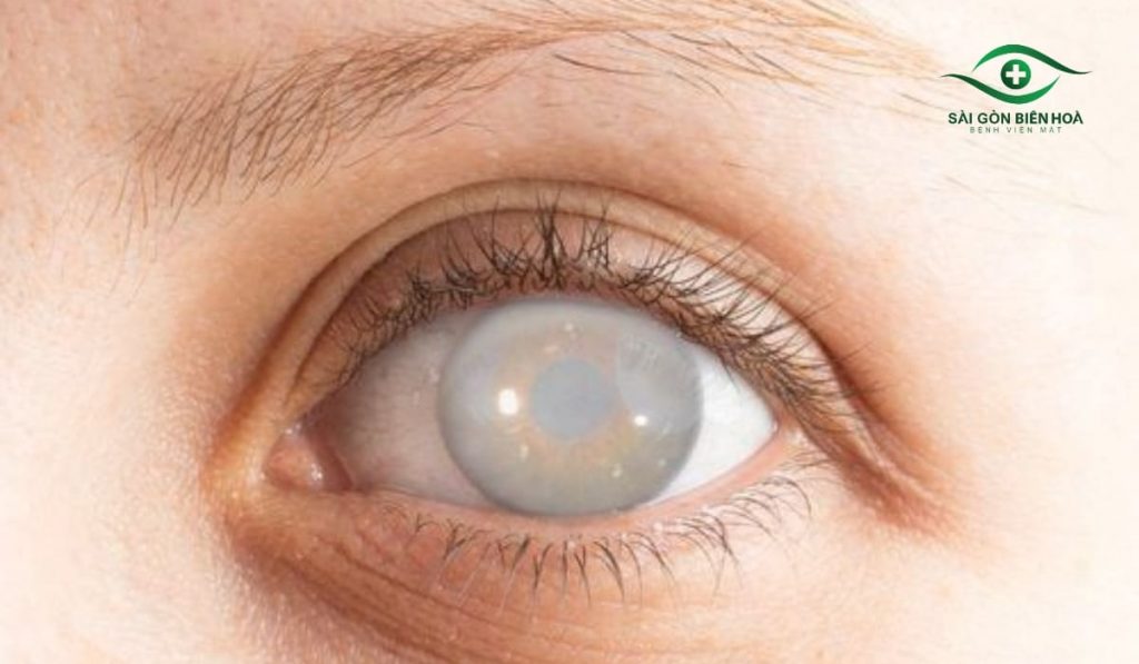 Các bệnh lý như đục thủy tinh thể có thể khiến mắt thấy quầng sáng xanh quanh đèn