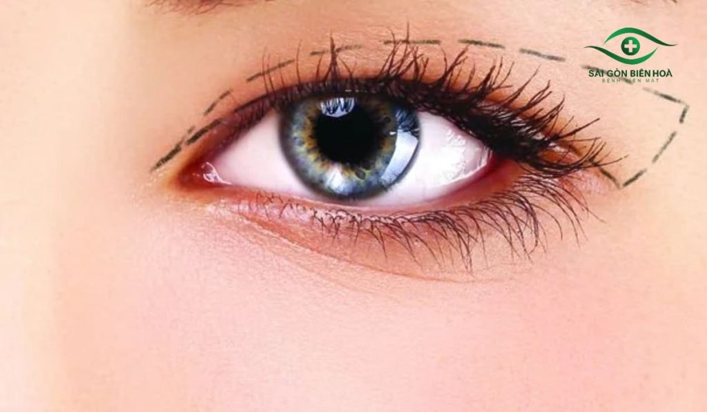 Cắt mí giúp tạo nếp mí rõ nét, cân đối và trẻ trung, hiệu quả lâu dài với bác sĩ chuyên khoa