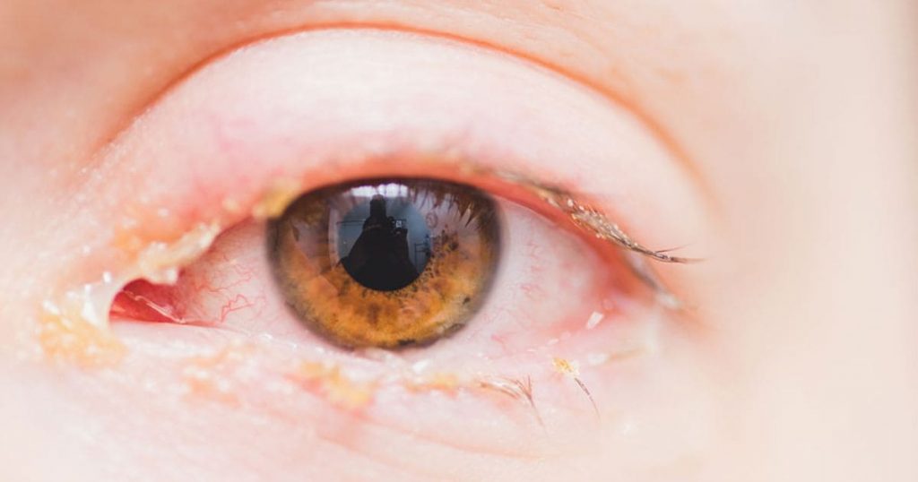 Đeo lens không đúng cách sẽ làm mắt nhiễm trùng