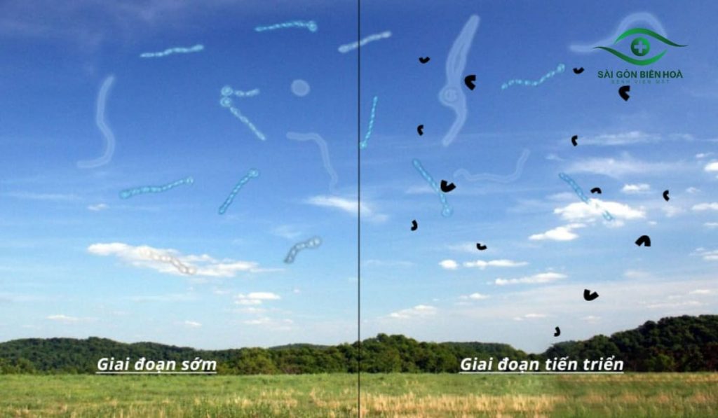Dịch kính là gel trong suốt giúp mắt giữ hình dạng và truyền sáng; khi thoái hóa có thể gây ruồi bay, bóng mờ