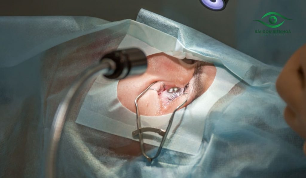 Điều trị mắt không tập trung bằng phẫu thuật khúc xạ hiện đại