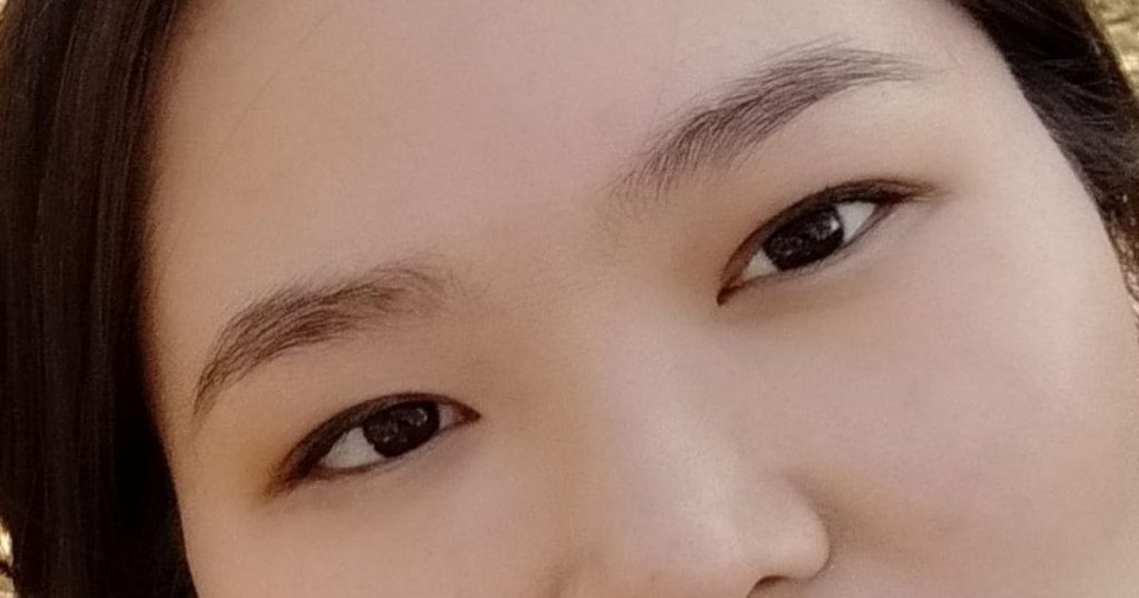 Do bị sụp mí mắt nên mắt bạn có thể trông nhỏ hơn