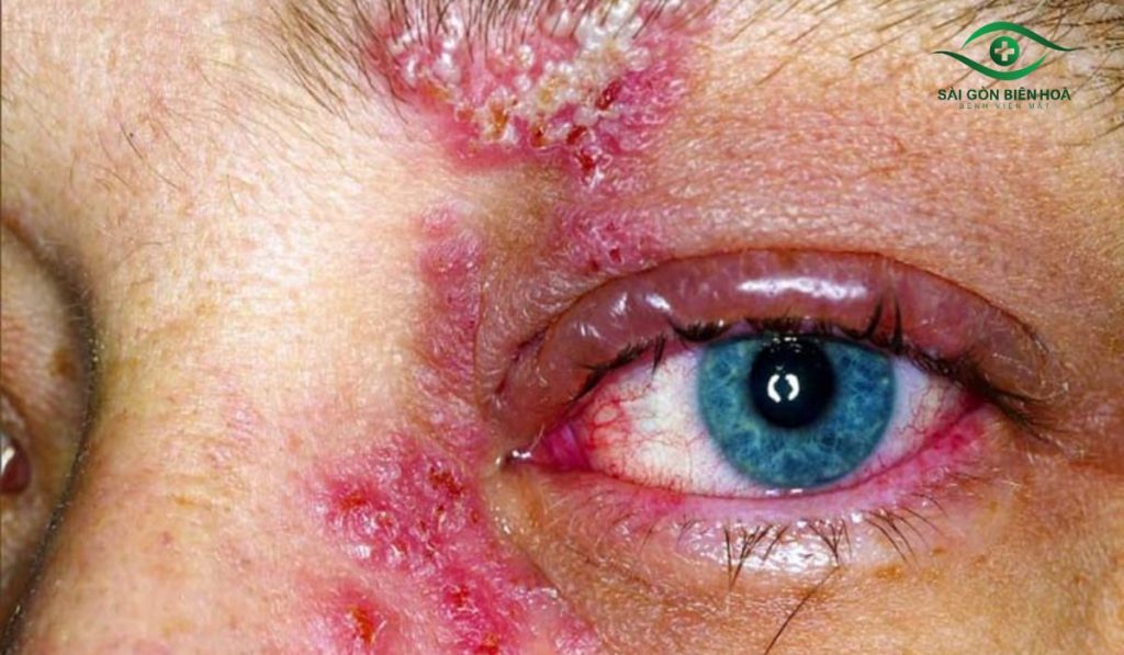 Giời leo ở mắt gây ngứa rát, mụn nước quanh mắt, sưng đỏ và nhạy cảm với ánh sáng