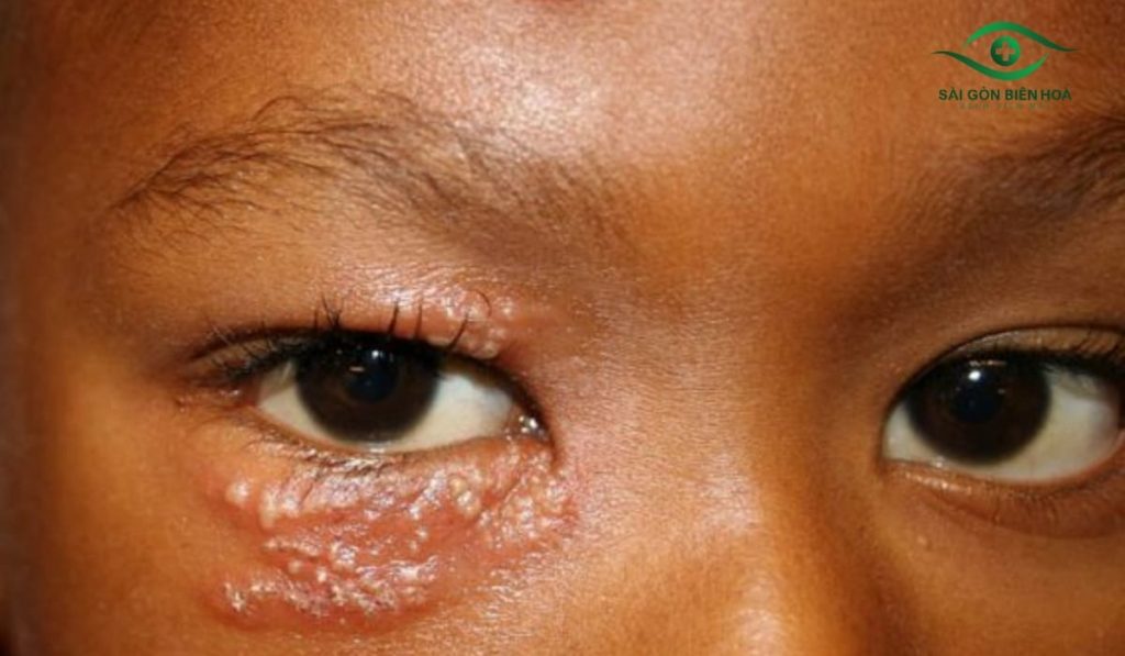 Giời leo ở mắt là do virus thủy đậu tái hoạt động, gây mụn nước, sưng đỏ và đau rát quanh mắt