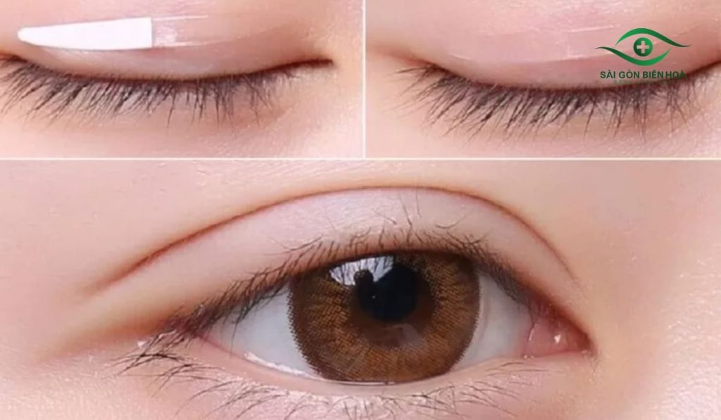 Khắc phục mắt nổ mắt xịt bằng trang điểm, miếng dán mí, massage hoặc can thiệp chuyên khoa