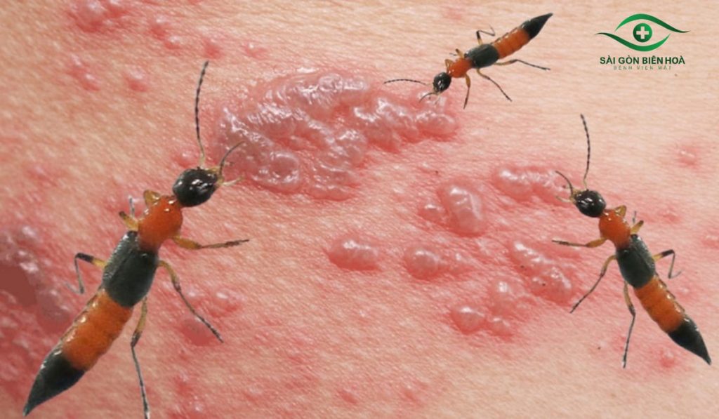 Kiến ba khoang đốt vào mắt có thể gây tổn thương sâu, giảm thị lực hoặc mù vĩnh viễn nếu không xử lý kịp thời