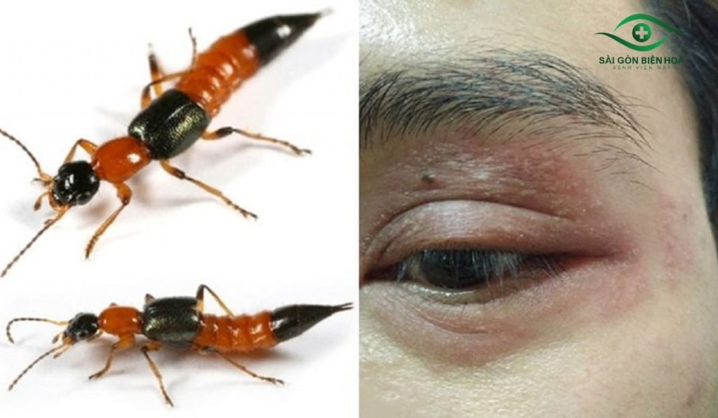 Kiến ba khoang đốt vào mắt gây sưng, bỏng rát, chảy nước mắt và nguy cơ giảm thị lực