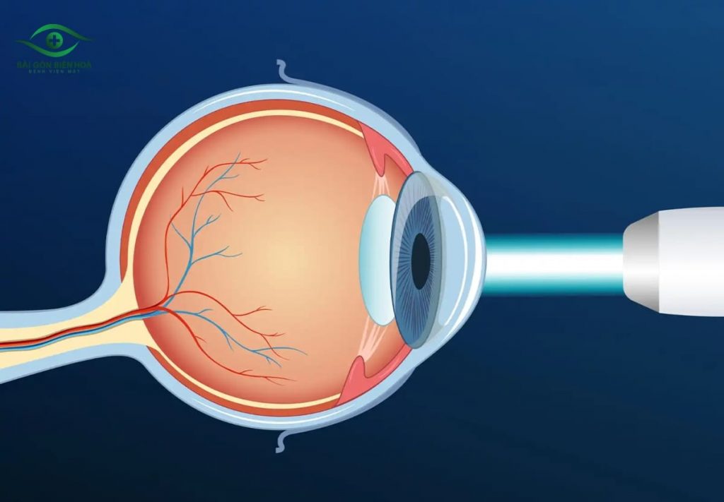 Laser YAG đang là phương pháp hiệu quả phổ biến để điều trị đục bao sau
