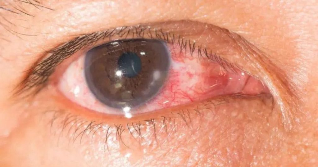 Mắt bạn có thể bị nhiễm trùng nếu đeo lens không đúng cách sau mổ