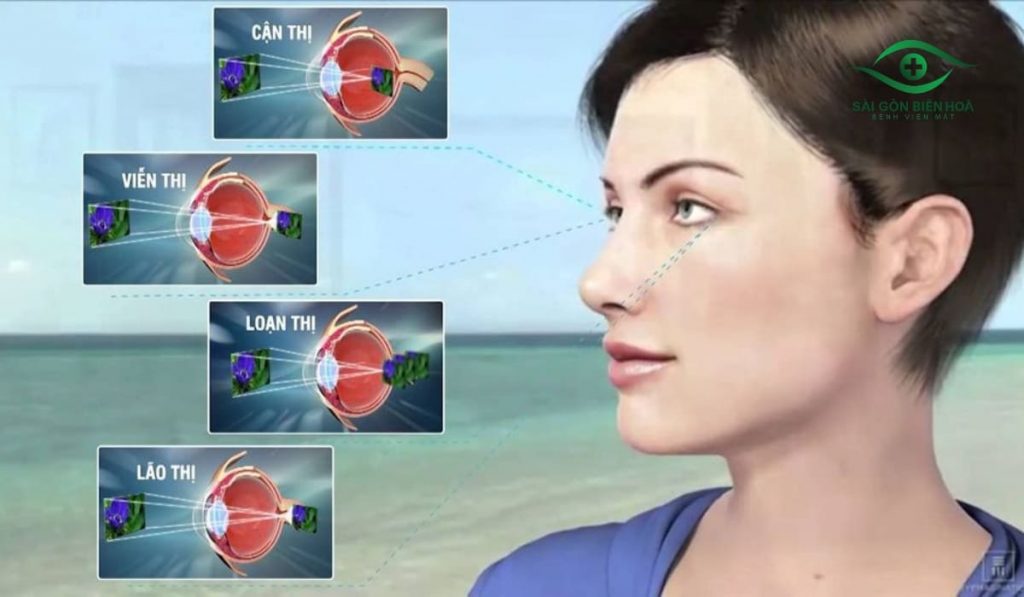 Mắt không tập trung do tật khúc xạ gây hình ảnh mờ, nhòe
