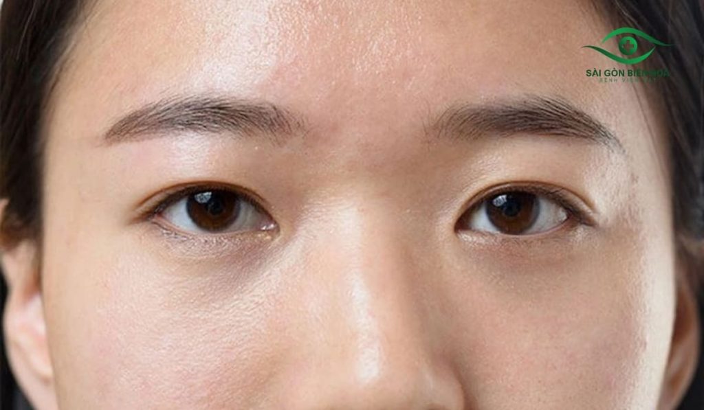 Mắt mí lót là tình trạng nếp mí mờ, ẩn dưới da, lúc trông như một mí, lúc lại giống hai mí