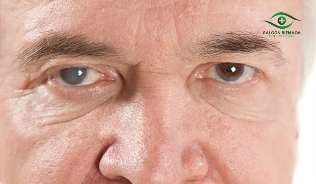 Mắt nhìn đèn thấy cầu vồng có thể là dấu hiệu tăng nhãn áp (glôcôm)