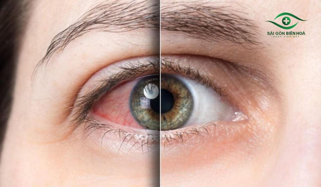 Mắt nhìn thấy cầu vồng có thể là dấu hiệu tăng nhãn áp, khi áp lực mắt cao gây phù giác mạc