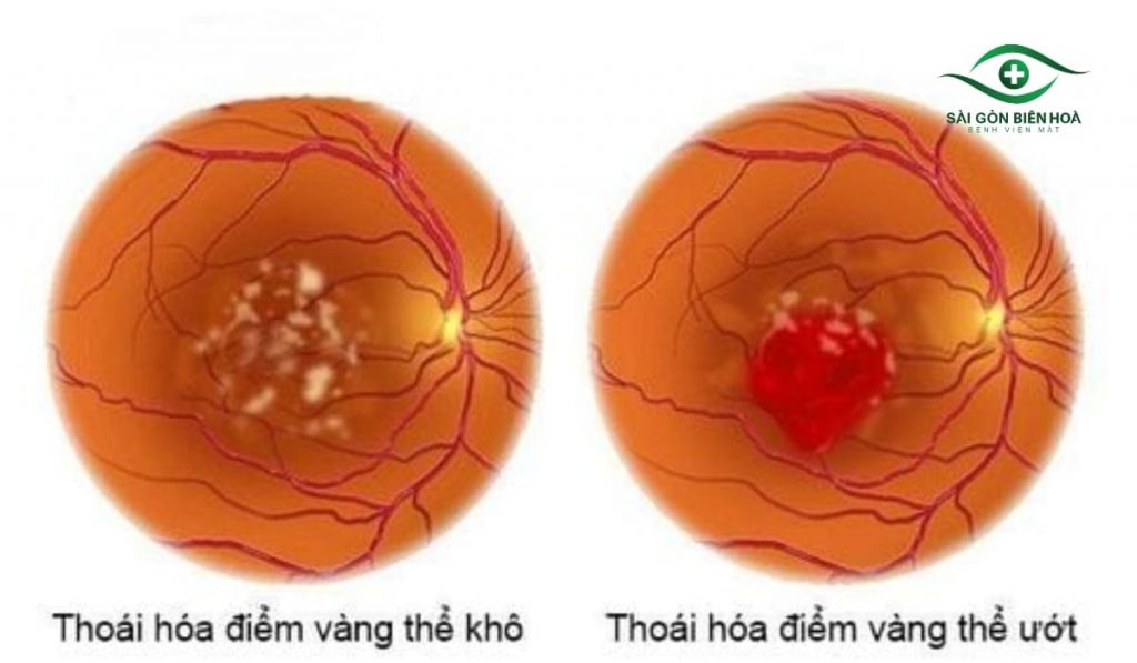 Mắt nhìn thấy gợn sóng do loạn thị, thoái hóa điểm vàng hoặc tổn thương võng mạc, khiến hình ảnh méo mó và mờ