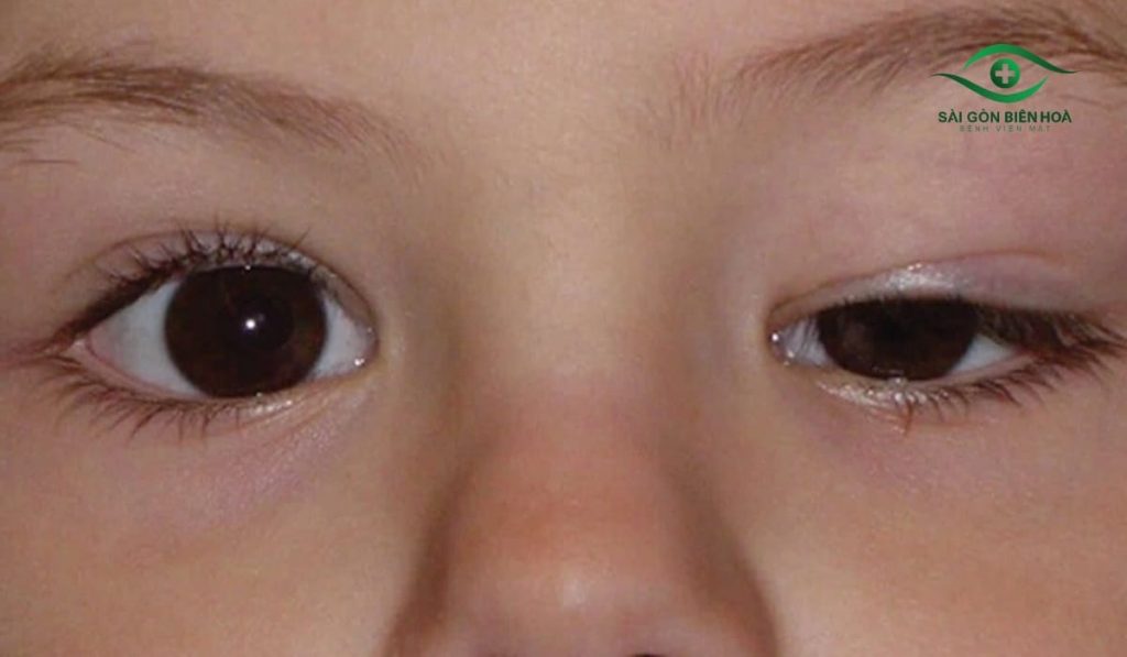 Mắt nổ mắt xịt thường do di truyền, bẩm sinh hoặc sụp mí mắt, khiến hai mắt không cân đối