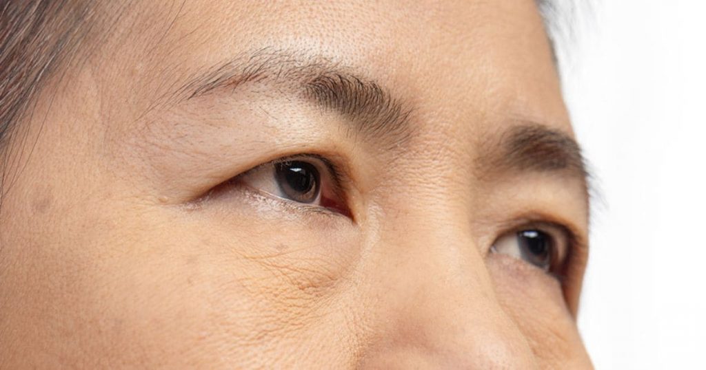 Mí mắt bị sụp gây khiến người bệnh “mất điểm” ngoại hình hơn