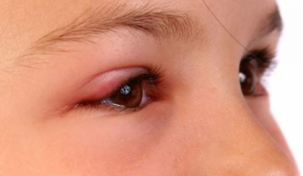 Mí mắt sưng đỏ, dính gỉ sau khi ngủ dậy có thể là dấu hiệu của viêm bờ mi