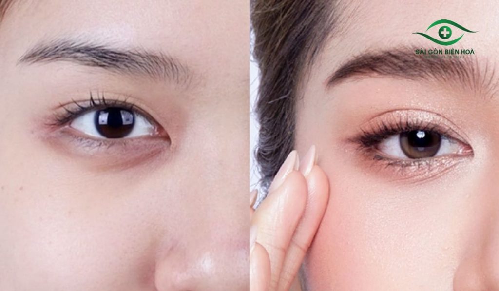 Miếng dán hoặc keo kích mí giúp tạo mắt hai mí tạm thời, nhưng không nên dùng quá thường xuyên