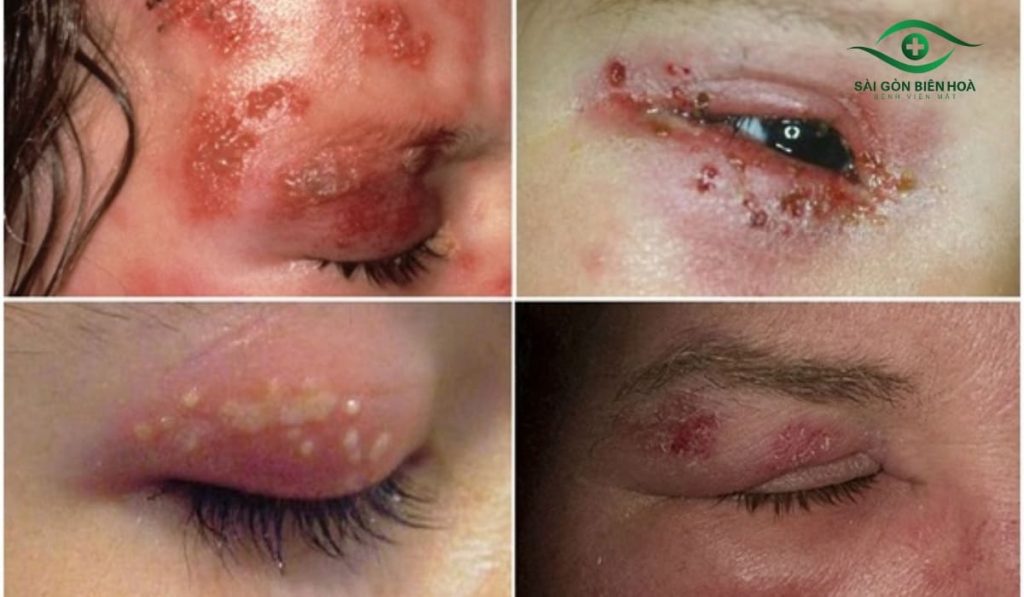 Trị giời leo ở mắt: dùng thuốc kháng virus sớm, giảm đau, nhỏ mắt và tái khám