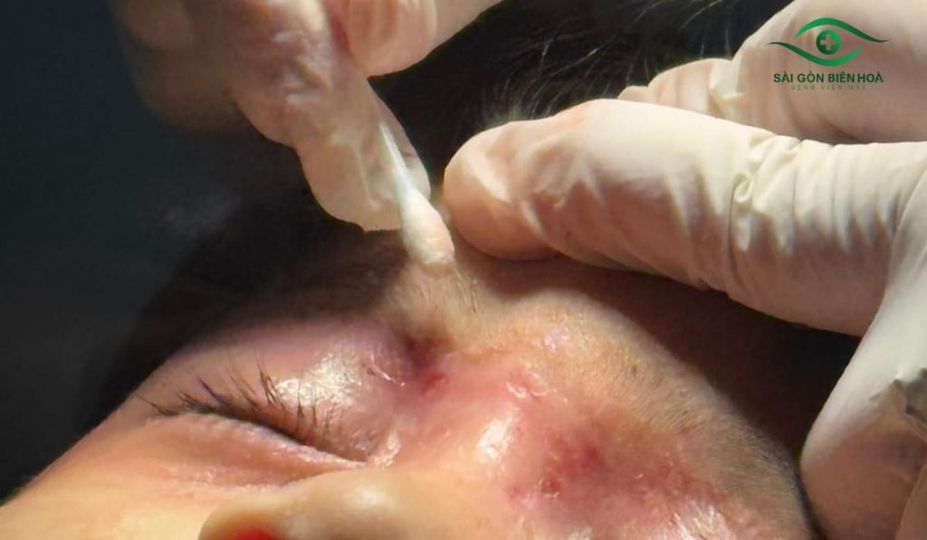 Xử lý kịp thời vết kiến ba khoang đốt: rửa, bôi thuốc, chăm sóc và đi khám nếu nặng