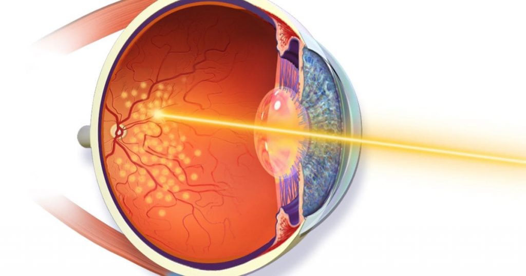 Bạn có thể được điều trị rách võng mạc bằng cách dùng Laser