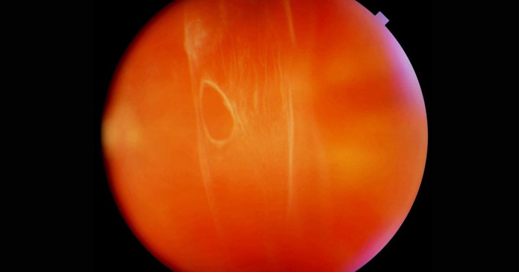 Bong dịch kính là một phần của quá trình lão hóa tự nhiên