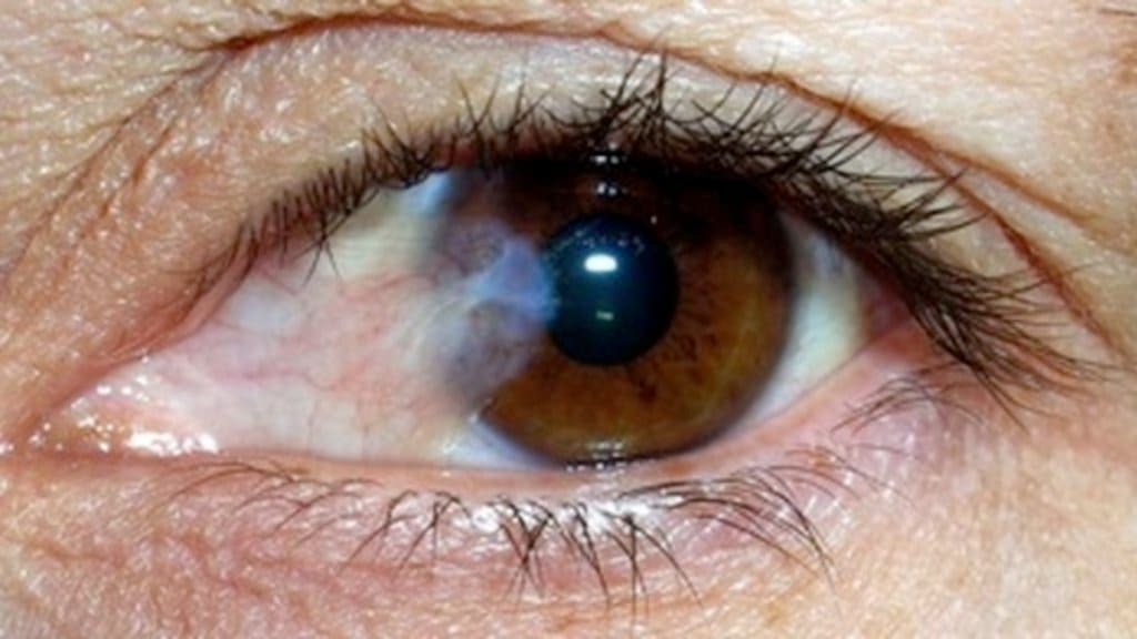 Bong võng mạc cũng là một trong những nguyên nhân gây ra ruồi bay trước mắt