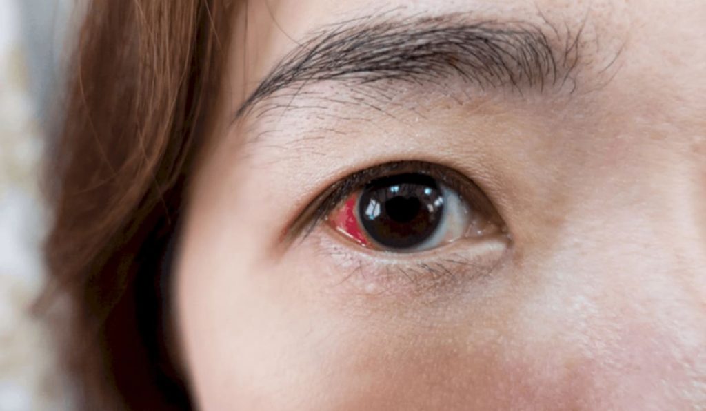 Bong võng mạc do cận thị nặng, trục nhãn cầu dài gây rách và xuất huyết dịch kính