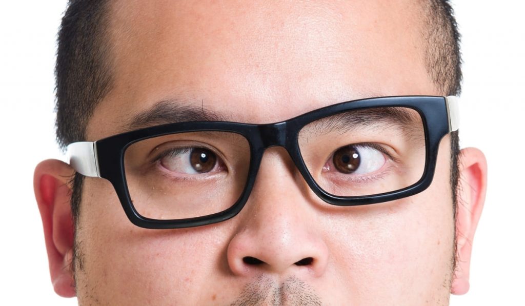 Cận thị nặng ảnh hưởng thẩm mỹ mắt: lác lé, mắt dại, sụp mí, mắt nhỏ và thay đổi dáng mắt