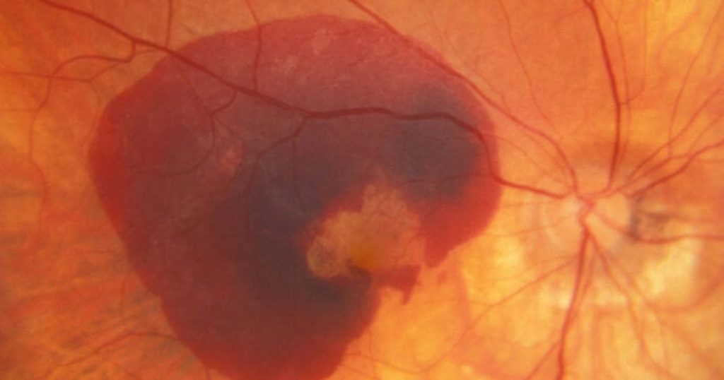 Điểm vàng bị thoái hoá cũng có thể khiến thị lực giảm dần