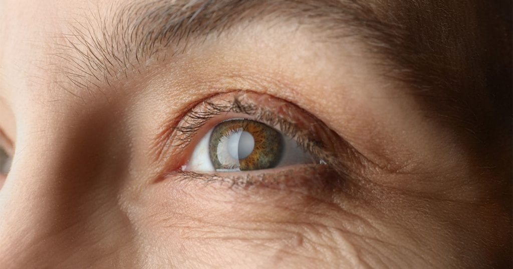 Đục thuỷ tinh thể là bệnh có thể điều trị được bằng cách phẫu thuật