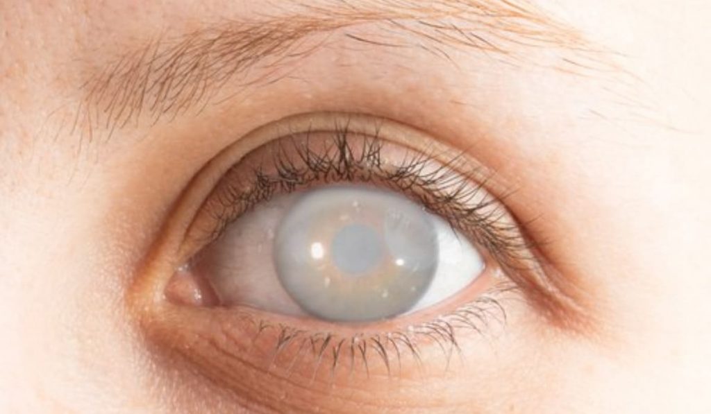 Đục thủy tinh thể ở người bị cận thị nặng làm thủy tinh thể mờ, giảm thị lực nghiêm trọng