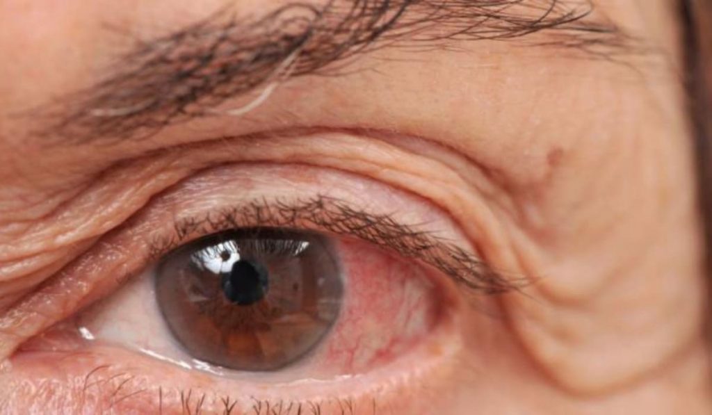 Glocom góc mở do cận thị nặng, tăng áp lực mắt, làm tổn thương dây thần kinh thị giác