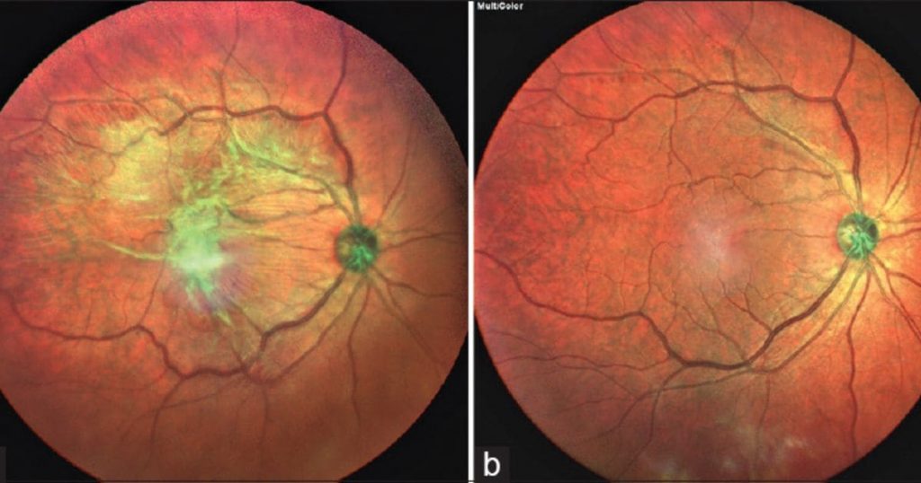 Màng trước võng mạc bất thường (a) và màng trên võng mạc bình thường (b)