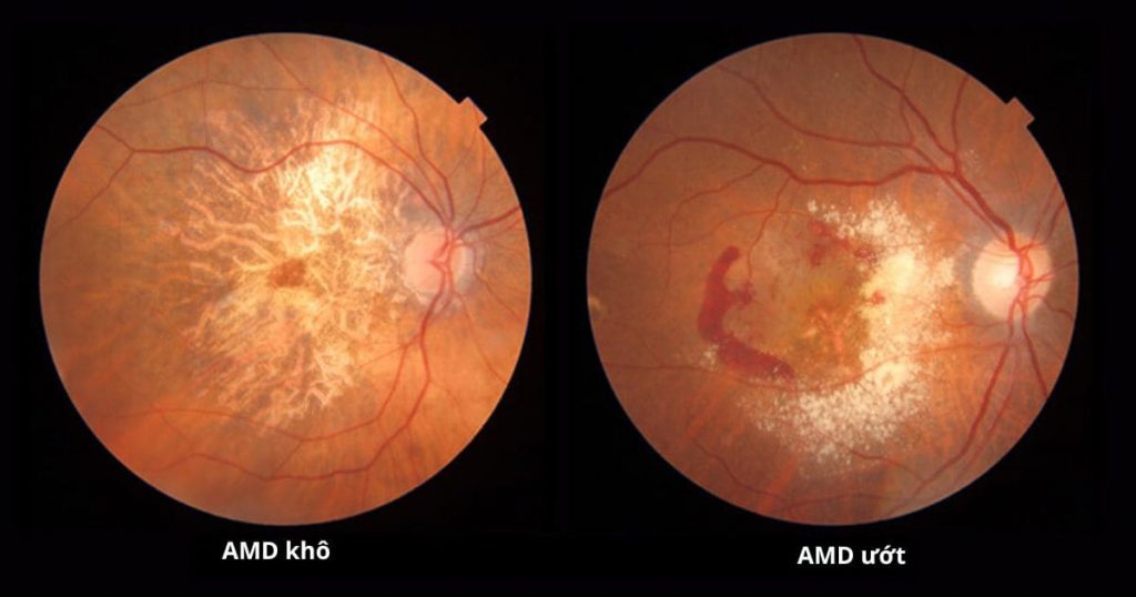 Minh hoạ hình ảnh võng mạc bị thoái hoá ở thể khô (bên trái) và thể ướt (bên phải)