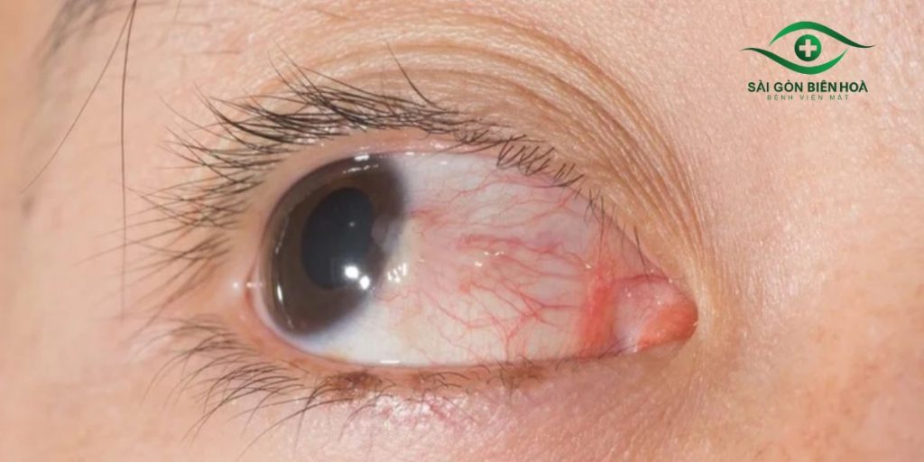 Mộng mắt vẫn có thể tái phát trở lại sau phẫu thuật