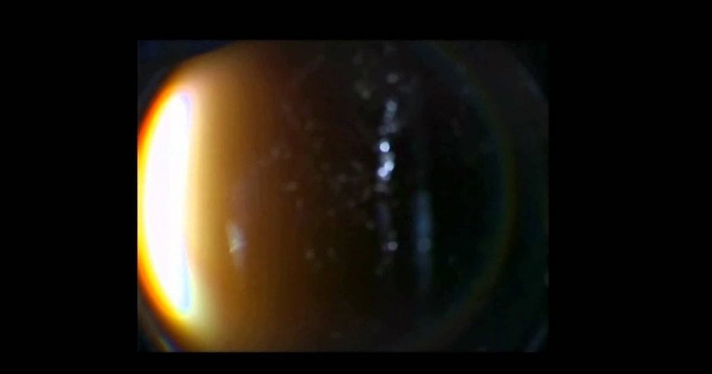 Người bị bong dịch kính có thể thấy nhiều tia sáng ở ngoài tầm nhìn