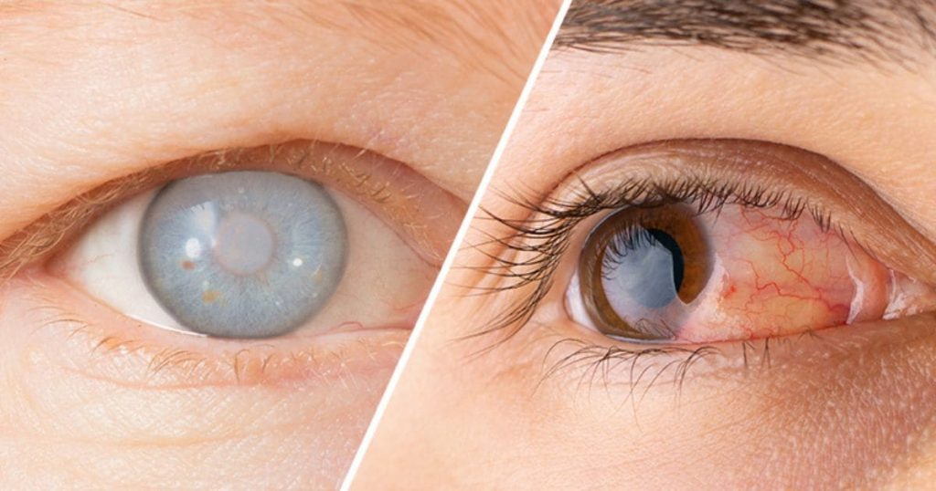 Những người có tiền sử bệnh lý về mắt như viêm võng mạc, đục thuỷ tinh thể có nguy cơ mắc bệnh cao hơn