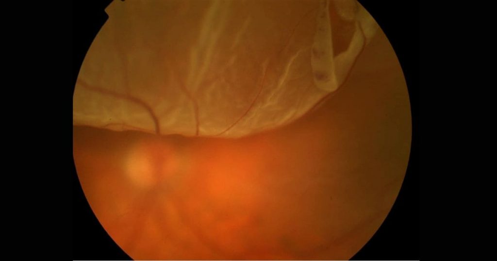 Rách võng mạc không điều trị kịp thời sẽ dẫn đến bong võng mạc