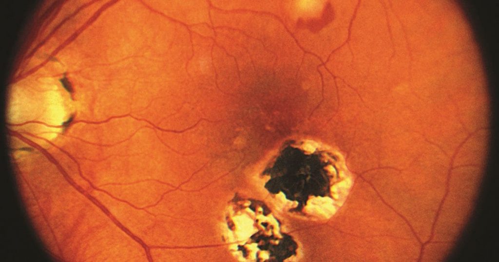 Sẹo có thể xuất hiện ở võng mạc khiến tầm nhìn người bệnh bị mờ