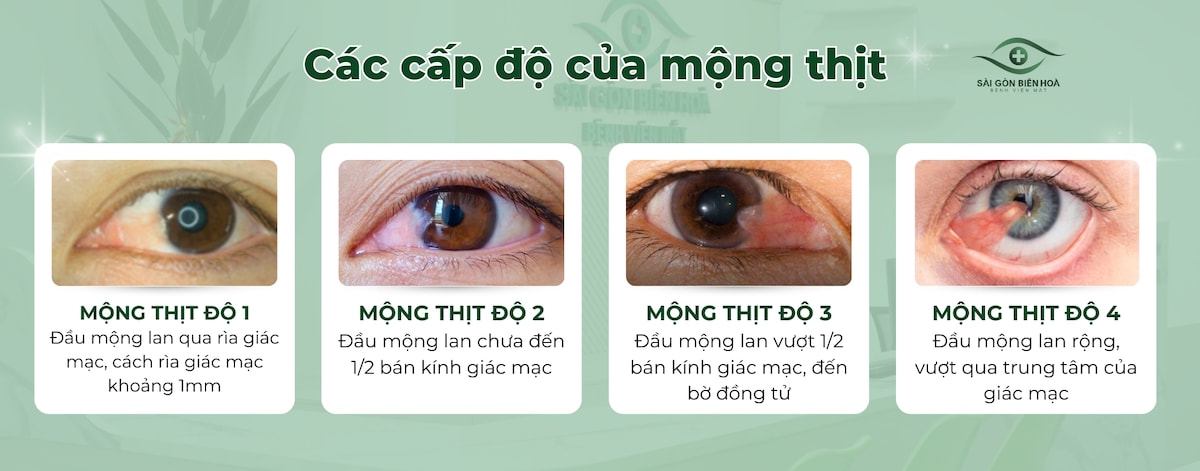 Các cấp độ của mộng thịt