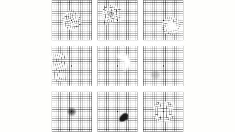 Để chẩn đoán bệnh, bác sĩ có thể chỉ định bệnh nhân kiểm tra mắt bằng lưới Amsler
