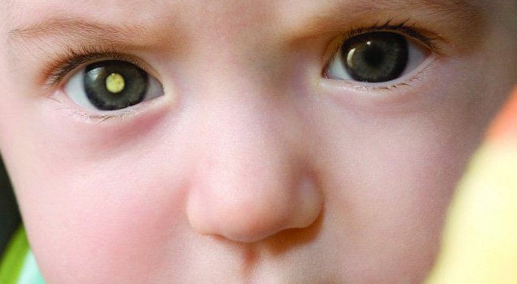 Đồng tử trẻ đột nhiên trắng là dấu hiệu chính phát để hiện u nguyên bào võng mạc