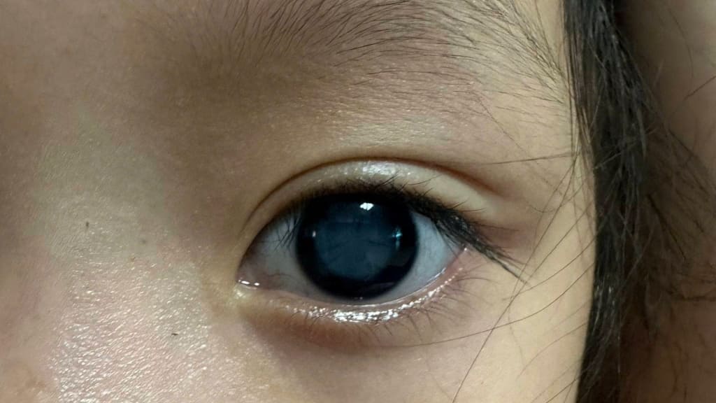 Đục thủy tinh thể là biến chứng muộn sau cắt dịch kính, có thể phải mổ Phaco